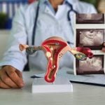 Fibroids Awareness Month 2026