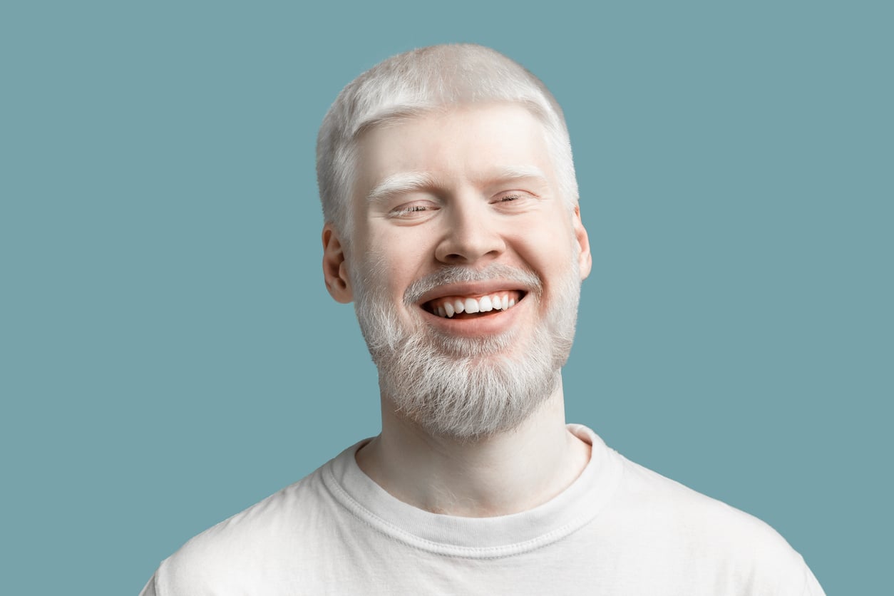 Person with albinism for International Albinism Awareness Day