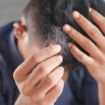 National Hair Loss Awareness Month